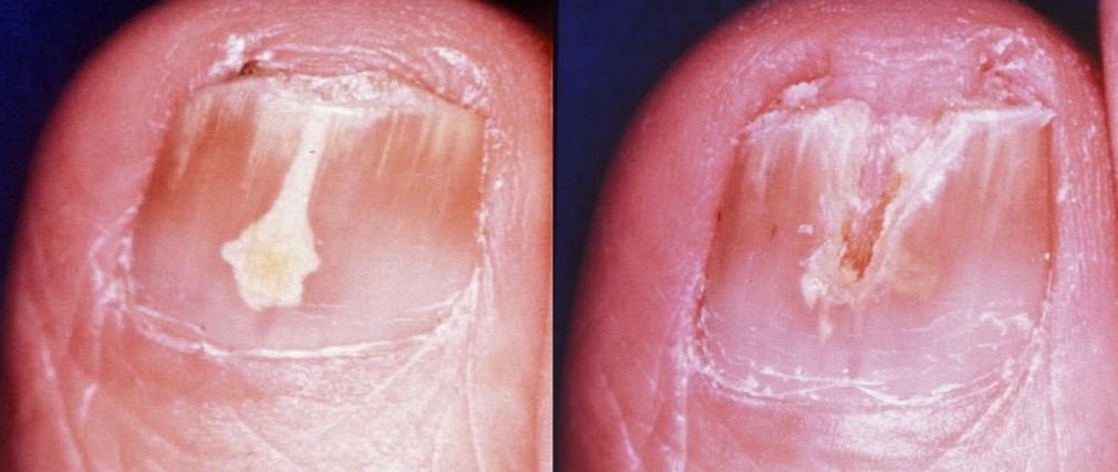 近位爪郭をケアする最良の方法は何ですか?